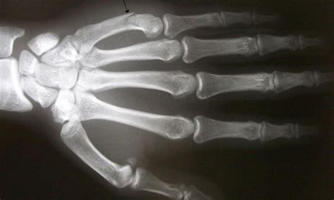 is there a boxer with metal hands|Boxer’s Fracture: Symptoms, Causes & Treatment .